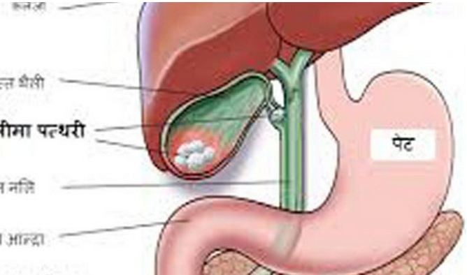 पित्तथैलीको पत्थरीबाट बच्ने उपाय (स्वास्थ्य टिप्स)