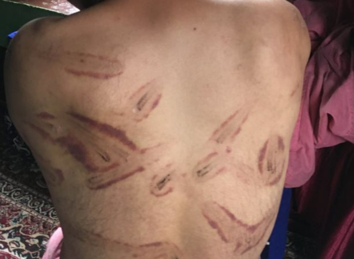 कश्मीरका जनताको पीडाः  सेनाले रड र केबलले कुटे, बिजुलीको झट्का दिए